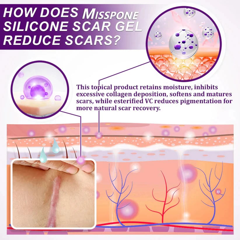 Misspone™ Face & Body Scar Gel – Clinically Proven Formula to Soften, Flatten & Fade Scars from Surgery, Acne, Burns, and Keloids