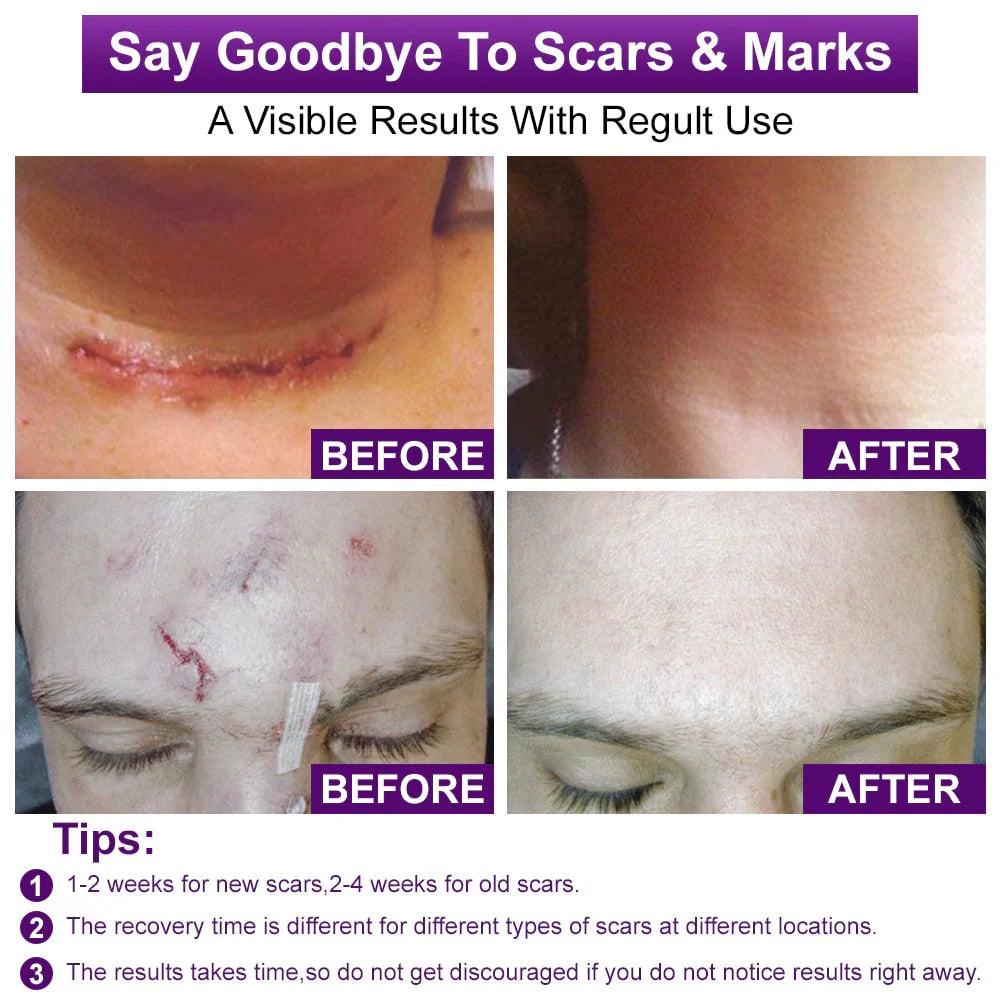 Misspone™ Face & Body Scar Gel – Clinically Proven Formula to Soften, Flatten & Fade Scars from Surgery, Acne, Burns, and Keloids