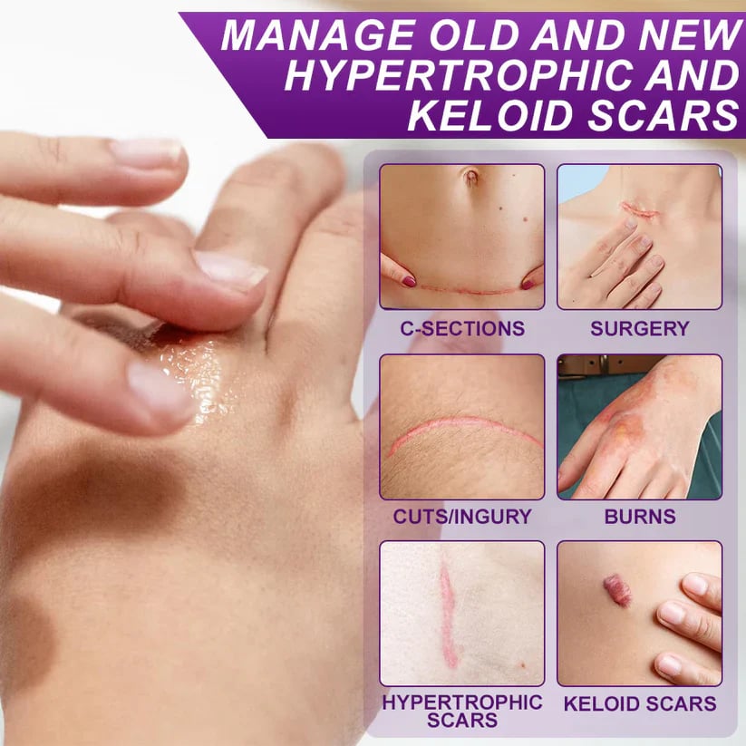 Misspone™ Face & Body Scar Gel – Clinically Proven Formula to Soften, Flatten & Fade Scars from Surgery, Acne, Burns, and Keloids