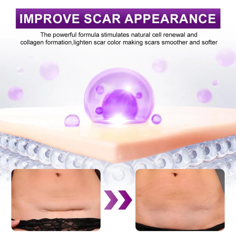 Misspone™ Face & Body Scar Gel – Clinically Proven Formula to Soften, Flatten & Fade Scars from Surgery, Acne, Burns, and Keloids